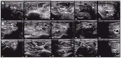 Nerve Ultrasound Comparison Between Transthyretin Familial Amyloid Polyneuropathy and Chronic Inflammatory Demyelinating Polyneuropathy